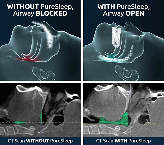 Bundle—PureSleep Anti-Snoring Mouthpiece and Cleaning Tablets