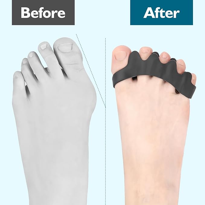 Toe Separators for Men and Women, 2PCS Toe Spacers for Foot Pain Relief, Bunion Corrector & Hammer Toe Straightener, Doctor Recommended Toe Spreaders for Alignment, Mobility & Foot Health