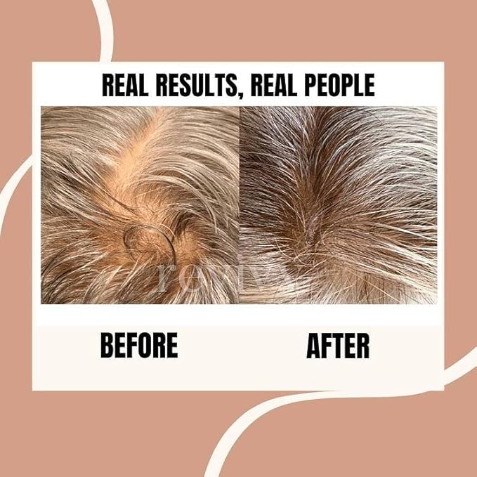 REVIVV Roller for Hair Rejuvenation – 0.25mm Roller for Scalp, Hair, Beard, Skin – 45 Day Supply