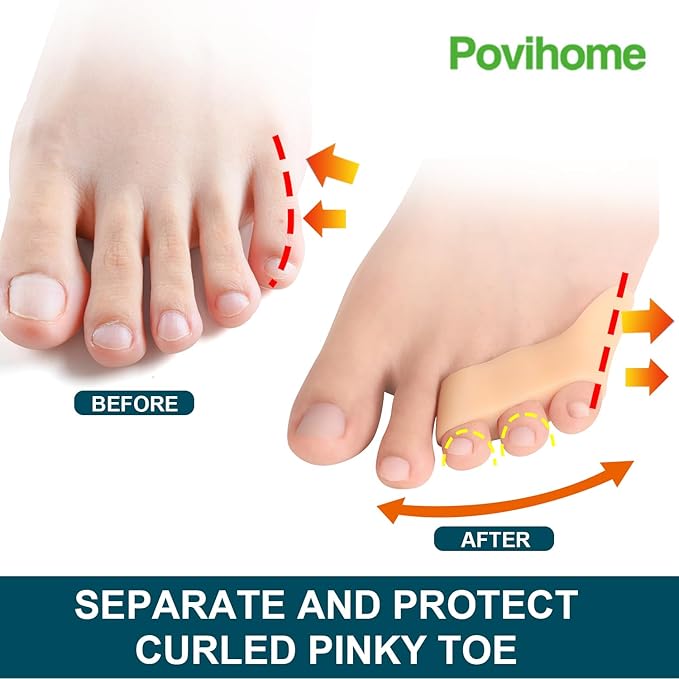 Povihome 10 Pack Pinky Toe Separator and Protectors, Triple Gel Toe Separators for Overlapping Toe, Curled Pinky Toes Separate and Protect (Beige)