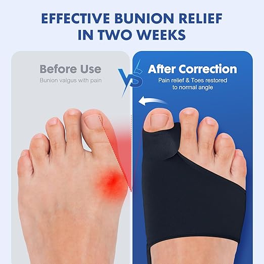 2PCS Bunion Corrector for Women & Men - Toe Alignment Corrector with Splint & Pads for Hallux Valgus Pain Relief, Comfortable Toe Separator for Day/Night Support, Anti Slip Big Toe Straightener(MNBK)