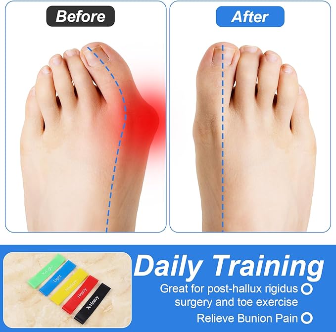 Sibba 5Pcs Toe Resistance Bands Toe Stretcher Bands for Bunion Correction Bunion Relief Toes Strength Foot Exercise Band for Hallux Valgus Yoga Daily Toes Training