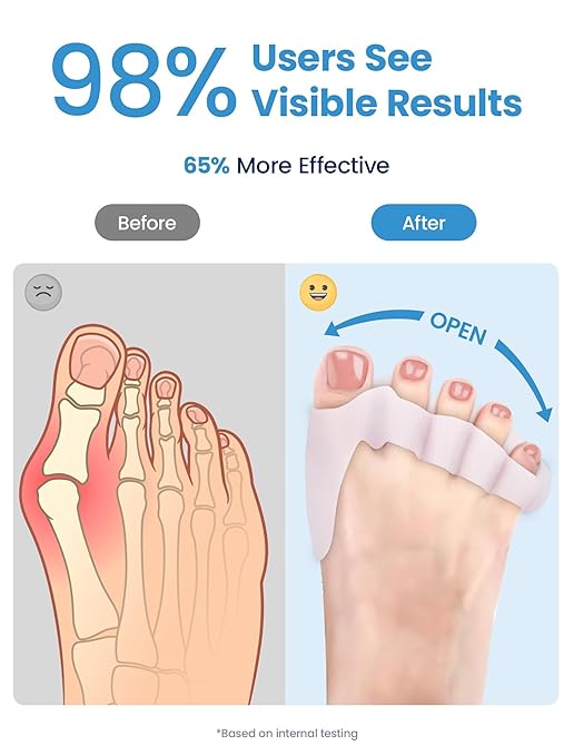 Toe Separators for Women - Podiatrist Recommended, Toe Spacers for Men, Breathable Bunion Corrector, Plantar Fasciitis(1 Pair)