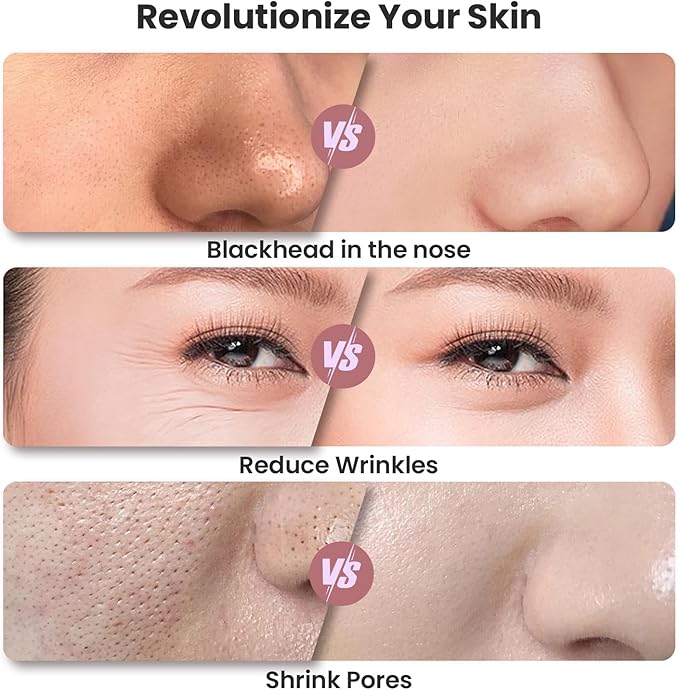 UNOISETION Diamond Microdermabrasion Machine, Portable Blackhead Remover Pore Vacuum, Dermabrasion Facial Machine for Exfoliation & Blackhead Removal