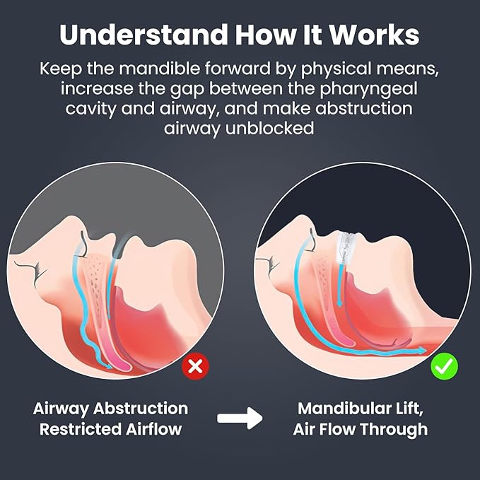 Anti Snore Mouthpiece - Adjustable Mouth Guard for Snoring, Reusable Nighttime Snoring Aid for Adults Men & Women-A09