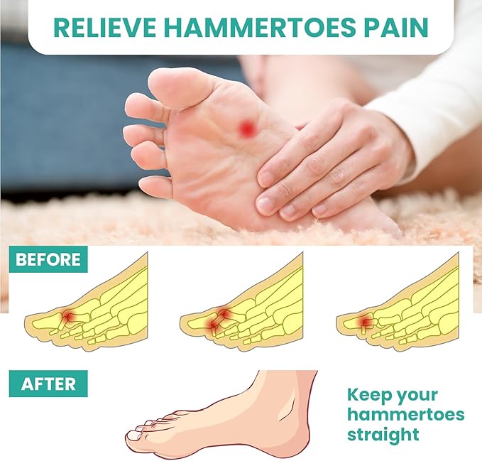 Welnove Hammer Toe Straightener Toe Corrector for Women - 8 Pcs Hammer Toe Cushion Pads for Bent, Crooked, Curled, Claw, and Hammer Toes - Soft Support and Realignment(Clear, One Loop Design)