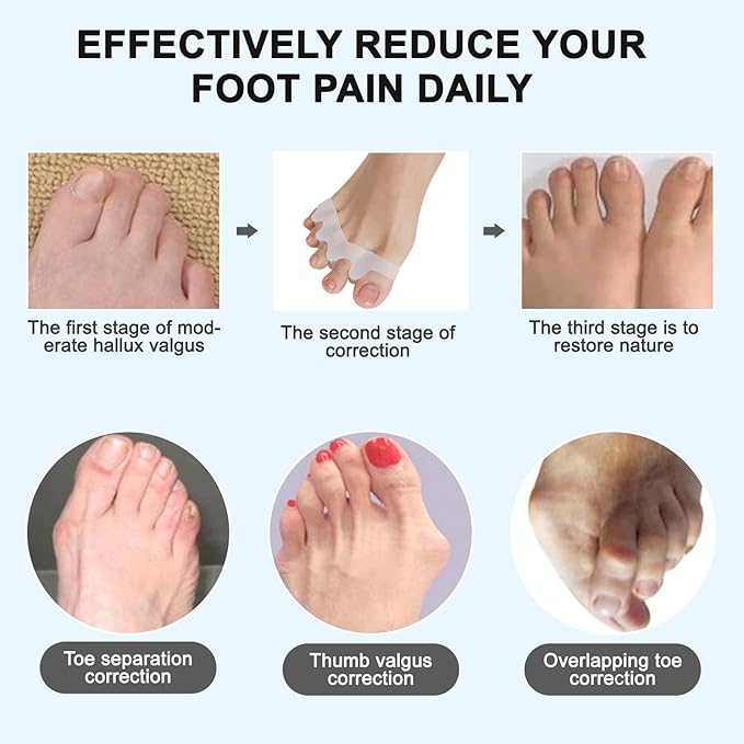 Toe Separators/Toe Spacers for Men and Women - Bunion Corrector & Hammer Toe Straightener for Overlapping Toes, Silicone Gel Pain Relief for Pedicure & Daily Care (White)