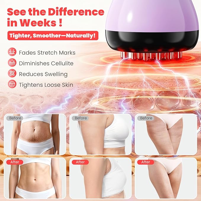 Lymphatic Drainage Massager, Anti-Cellulite Massager For Body Cellulite and Thigh & Belly Stretch Marks Reduction, Handheld Massage tools for lymphedema & lipedema, Sciatica Nerve pain relief Devices