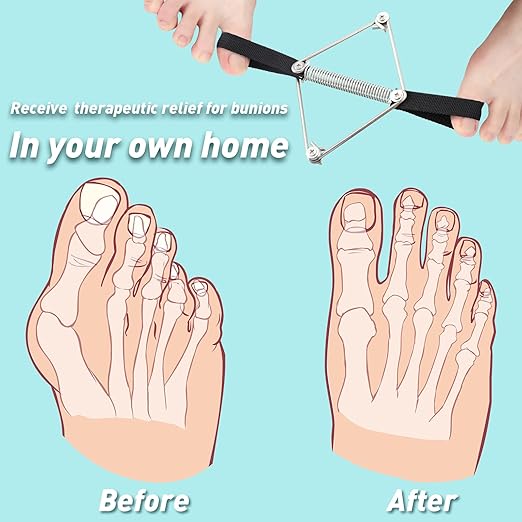 Tondiamo Pilates Toe Stretcher Bunion, Hallux Valgus Big Toe Strap Spacer Tension Bunion Exercise Band Stretchy Alignment Splint Restores Pain Relief for Women Men