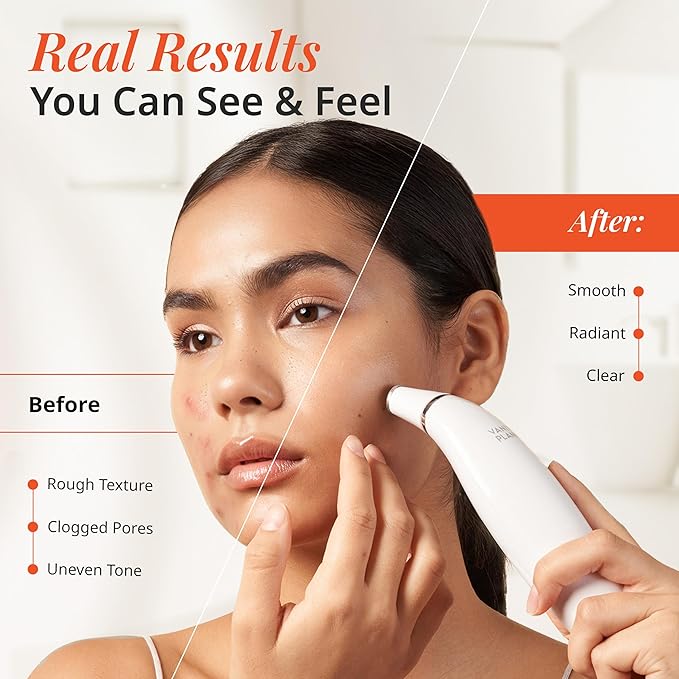 Vanity Planet Exfora Facial Microdermabrasion Wand - Pore Vacuum, Blackhead Remover, Acne Exfoliator, Wrinkles Reducer for All Skin Types - Microdermabrasion Machine with 4 Heads & Dual Charging Mode