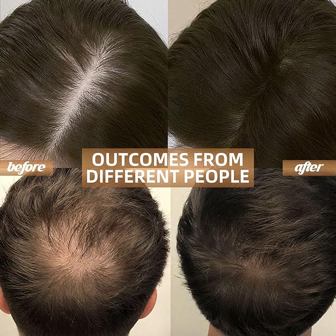 Laser Hair Growth Cap,Red Light Therapy for Hair Growth in Women and Men, Hair Loss Treatments Hat, Laser Red Light Therapy for Hair Growth System