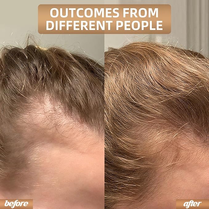Laser Hair Growth Cap,Red Light Therapy for Hair Growth in Women and Men, Hair Loss Treatments Hat, Laser Red Light Therapy for Hair Growth System
