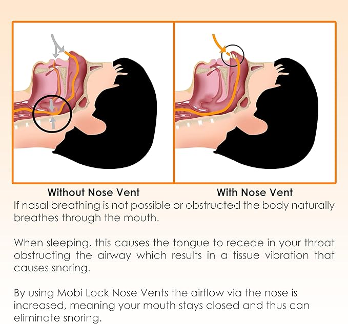 Nose Vent Sinus Relief (Pack of 12 XL Size) Hard Silicone Vents - A Simple Solution for Nasal Snorers - Reusable Snoring Device to Enjoy a Peaceful Night's Sleep - by Mobi Lock